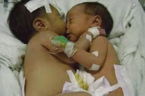 Những ca tách song sinh dính liền thành công tại Việt Nam