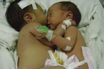 Những ca tách song sinh dính liền thành công tại Việt Nam