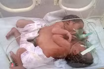 Cặp song sinh dính liền ở Hà Giang đã tử vong