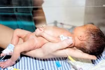 Xót xa nhưng em bé mắc bệnh xương thủy tinh