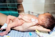 Xót xa nhưng em bé mắc bệnh xương thủy tinh