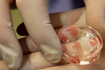 Nguyên nhân sảy thai sau thụ tinh ống nghiệm