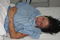 Bệnh nhân viêm màng não mô cầu ở Hà Nội đã hồi phục