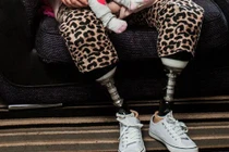 Bác sĩ lơ là, sản phụ phải cắt bỏ chân sau sinh mổ