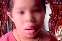 Môi sưng vù, biến dạng vì ngậm đồ chơi Trung Quốc