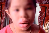 Môi sưng vù, biến dạng vì ngậm đồ chơi Trung Quốc