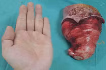 Phẫu thuật cắt bỏ lưỡi khổng lồ cho cụ bà ở Hà Giang