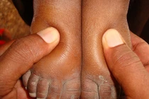 Lý do bệnh viêm cầu thận nguy hiểm hơn bạn nghĩ