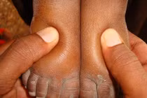 Lý do bệnh viêm cầu thận nguy hiểm hơn bạn nghĩ