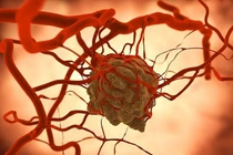 Phương pháp trị ung thư của học sinh Việt đoạt giải quốc tế