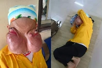 Đau đớn triền miên vì 2 khối u khổng lồ ở mắt