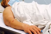 HN quyết liệt ngăn viêm não mô cầu bùng phát dịch