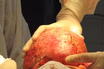 Các bước chẩn đoán khối u lành hay ác tính