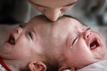 Rớt nước mắt hình ảnh các cặp song sinh dính liền 