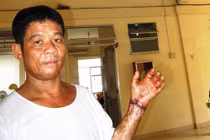 Nối lại thành công bàn tay bị rựa chém đứt rời