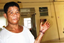 Nối lại thành công bàn tay bị rựa chém đứt rời