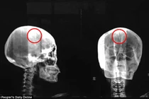 Kinh hãi người phụ nữ bị kẹt kim dài 5 cm trong đầu