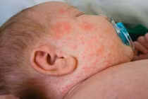 Phòng dịch sởi quay lại, Bộ Y tế khuyến cáo khẩn