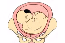 Nhận biết các kiểu ngôi thai nguy hiểm