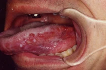 Hành trình chữa khỏi bệnh ung thư của Michael Douglas