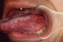 Hành trình chữa khỏi bệnh ung thư của Michael Douglas