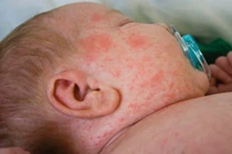 Dịch sởi bùng phát: hệ quả từ nỗi ám ảnh vắc-xin?