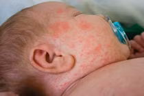 Dịch sởi bùng phát: hệ quả từ nỗi ám ảnh vắc-xin?