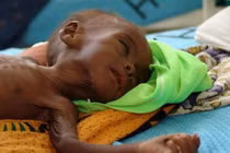 Dấu hiệu nguy hiểm con bạn suy dinh dưỡng nặng 