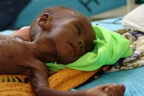 Dấu hiệu nguy hiểm con bạn suy dinh dưỡng nặng 