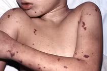 Đối tượng dễ mắc viêm màng não mô cầu