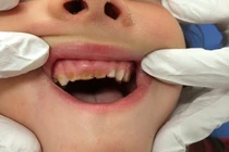 Thói quen dễ mắc làm hỏng răng sữa của bé