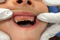 Thói quen dễ mắc làm hỏng răng sữa của bé