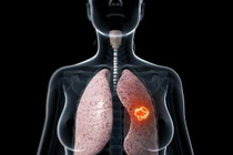 10 bệnh ung thư phụ nữ Việt hay mắc nhất