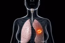 10 bệnh ung thư phụ nữ Việt hay mắc nhất