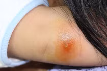 14 căn bệnh bé dễ gặp khi còn nhỏ