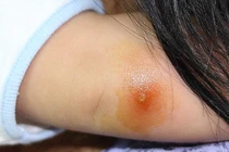 14 căn bệnh bé dễ gặp khi còn nhỏ