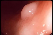 Bốn bệnh ung thư thường gặp ở tuổi 20