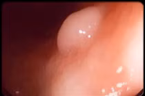 Bốn bệnh ung thư thường gặp ở tuổi 20