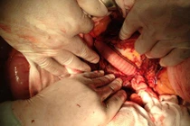 Ghép thành công mạch máu cứu sống bệnh nhân bị hoại tử