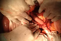 Ghép thành công mạch máu cứu sống bệnh nhân bị hoại tử