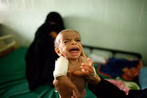 Cách chăm sóc trẻ suy dinh dưỡng hợp lý