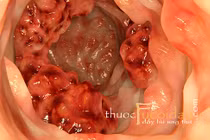 Nguyên nhân 7 loại bệnh ung thư phụ nữ dễ mắc nhất