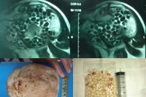 Rùng mình những viên sỏi “lúc nhúc” trong cơ thể 