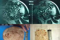 Rùng mình những viên sỏi “lúc nhúc” trong cơ thể 