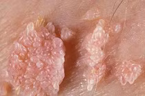 Dấu hiệu bệnh sinh dục rất dễ thấy trên da bạn