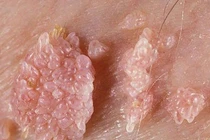 Dấu hiệu bệnh sinh dục rất dễ thấy trên da bạn