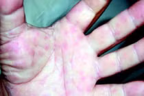 Mùa nóng: Đừng nhầm lẫn viêm màng não mô cầu với cháy nắng