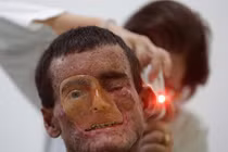 Bệnh da khủng khiếp ở Phú Thọ là do hôn nhân cận huyết?