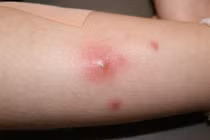 Mẹo đắp bánh mì trị mụn nhọt hiệu quả bất ngờ