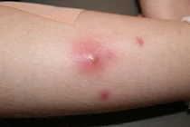 Mẹo đắp bánh mì trị mụn nhọt hiệu quả bất ngờ